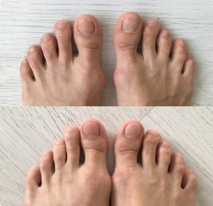 Antes y después de usar el spray Foot tropper